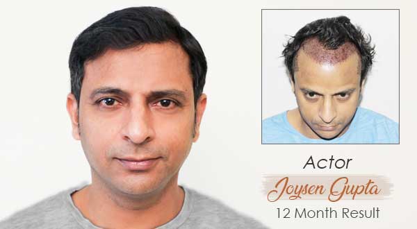 Hair Transplant in Jaipur | Delhi | Hair Transplant Cost in Jaipur