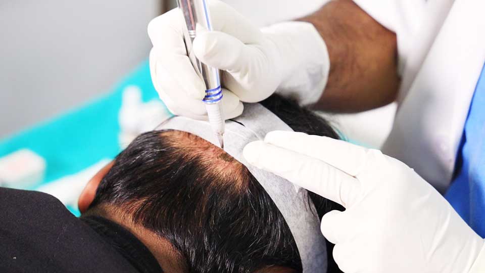 Scalp Micropigmentation - Creative Hair Clinic - Leixlip