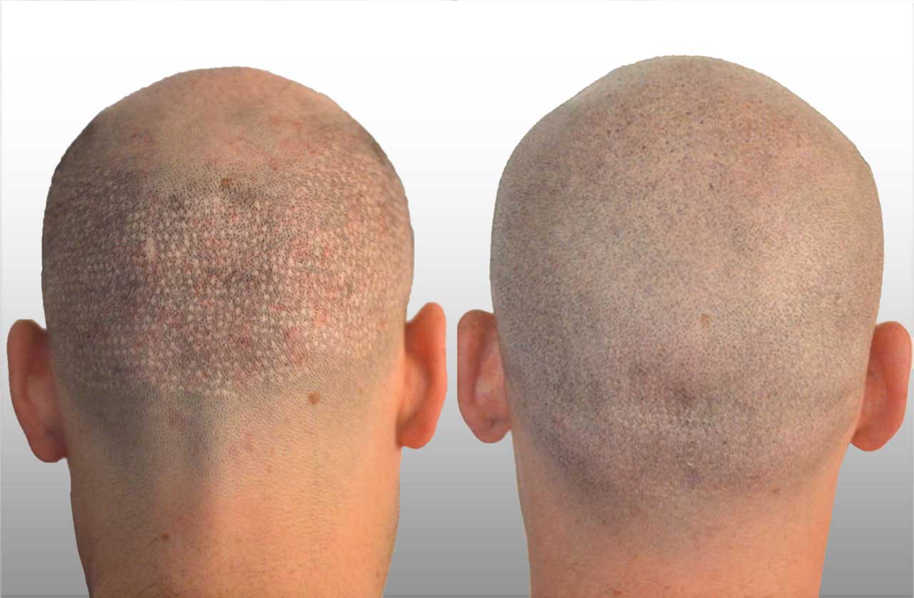 Scalp Micropigmentation in India