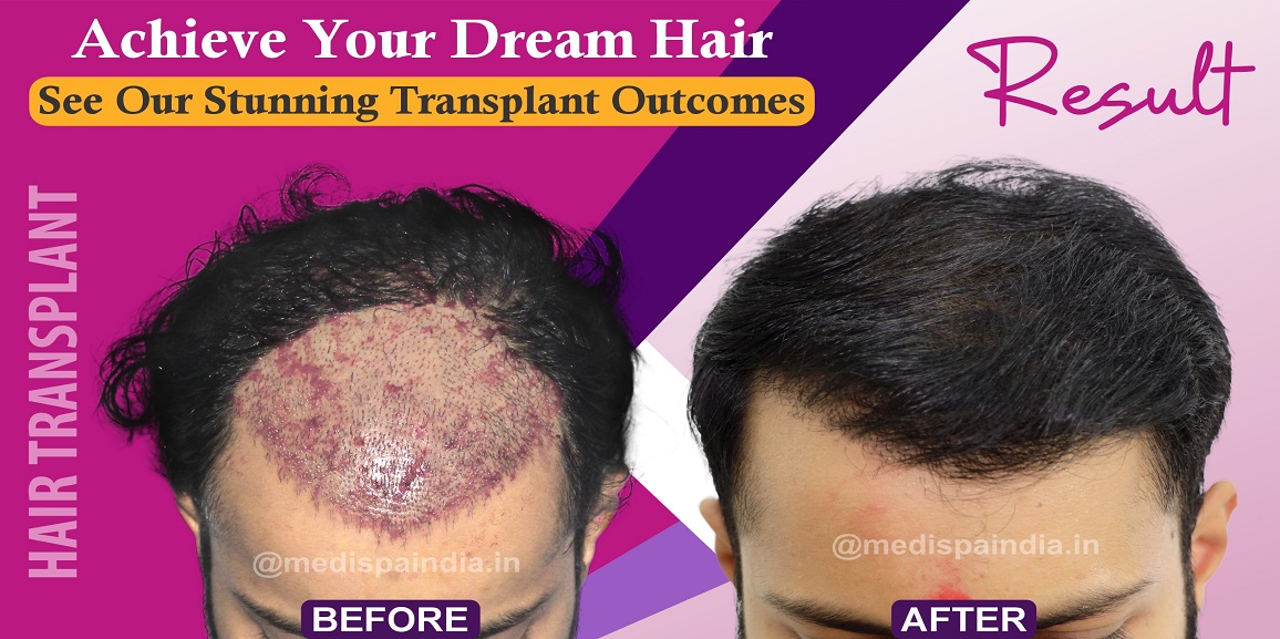 After hair outlet transplant