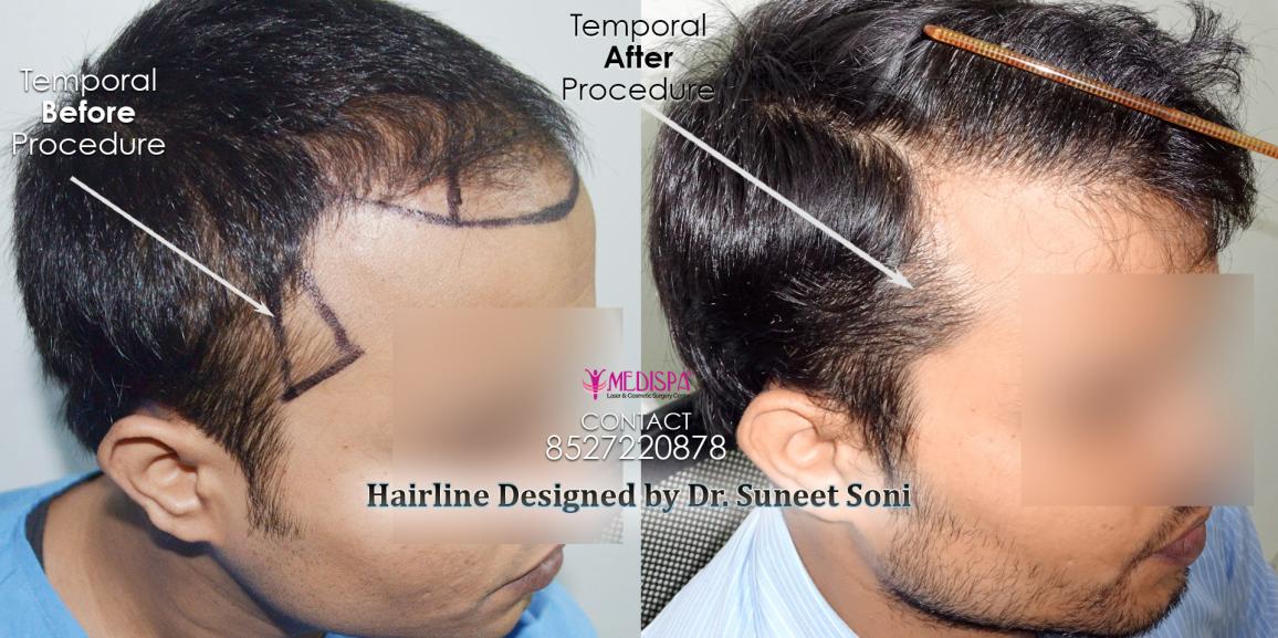 5 Best Hair Transplant Doctors In India